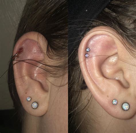 cartilage piercing blister|bleeding from piercing cartilage.